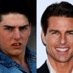 Tom Cruise before and after plastic surgery 04