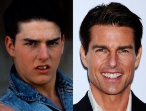 Tom Cruise before and after plastic surgery 04