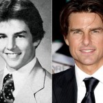 Tom Cruise before and after plastic surgery 05