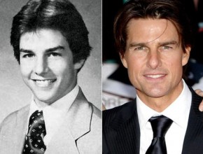 Tom Cruise before and after plastic surgery 05