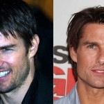 Tom Cruise before and after plastic surgery 06