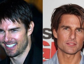 Tom Cruise before and after plastic surgery 06