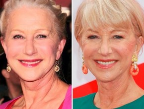 Helen Mirren after and before plastic surgery