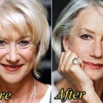 Helen Mirren before and after plastic surgery 04