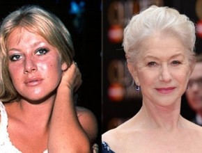Helen Mirren before and after plastic surgery