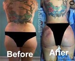 Kailyn Lowry before and after Brazilian butt lift