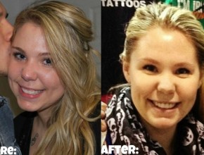 Kailyn-Lowry-plastic-surgery-11