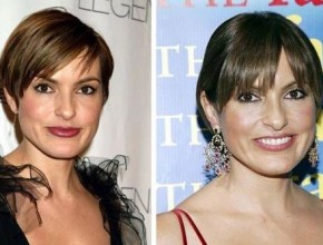 Mariska Hargitay before and after plastic surgery (1)