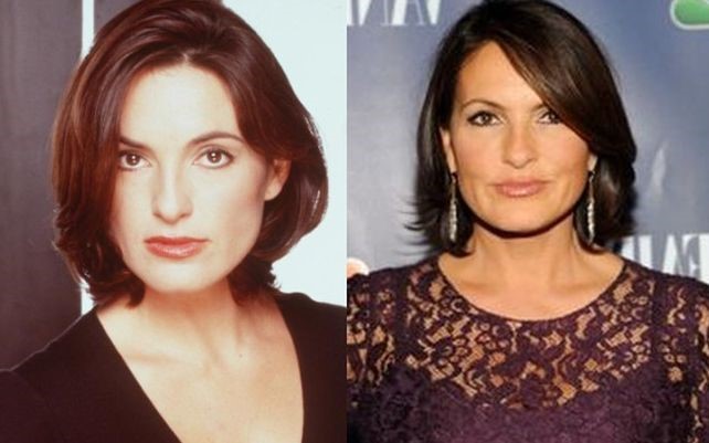 Mariska Hargitay before and after plastic surgery