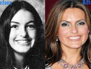 Mariska Hargitay before and after plastic surgery (5)