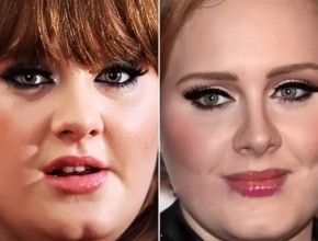 Adele before and after plastic surgery (13)