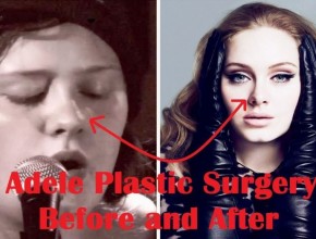 Adele before and after plastic surgery (21)