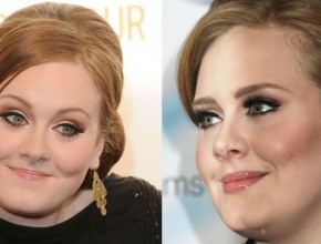 Adele before and after plastic surgery (4)