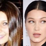 Bella Hadid Plastic Surgery (1)