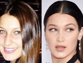 Bella Hadid Plastic Surgery (1)