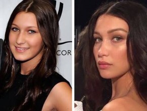 Bella Hadid Plastic Surgery