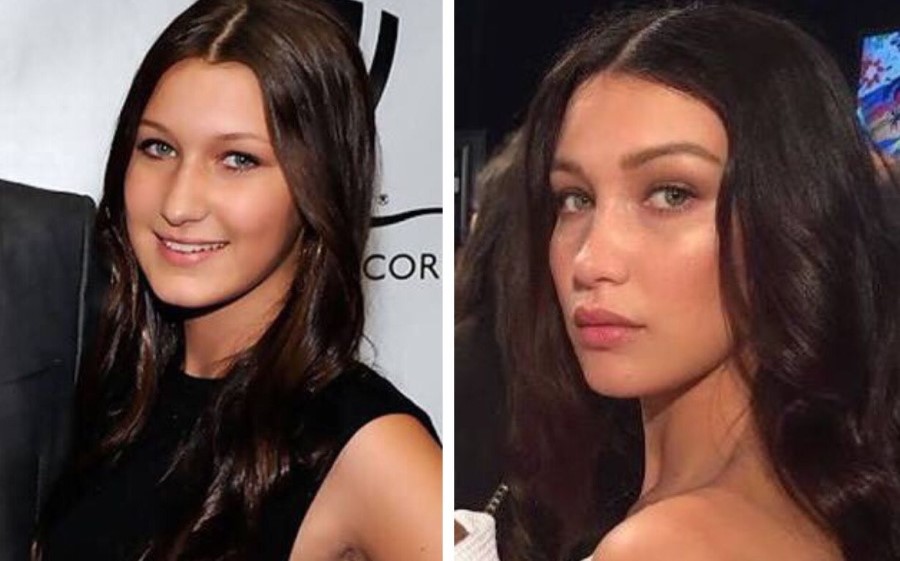 Bella Hadid Plastic Surgery 