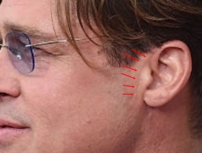 Brad Pitt plastic surgery facelift scar (27)