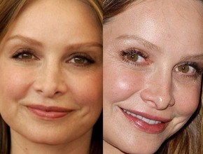 Calista Flockhart before and after plastic surgery (17)