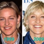 Ellen DeGeneres before and after plastic surgery (12)