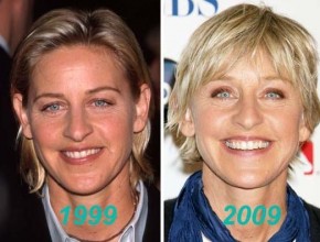 Ellen DeGeneres before and after plastic surgery (12)