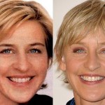 Ellen DeGeneres before and after plastic surgery (13)