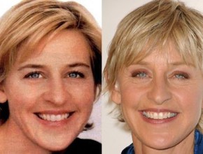 Ellen DeGeneres before and after plastic surgery (13)