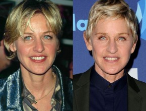 Ellen DeGeneres before and after plastic surgery