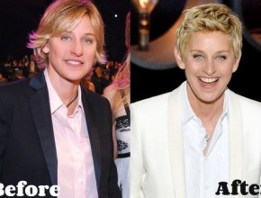 Ellen DeGeneres before and after plastic surgery (9)