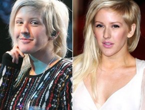 Ellie Goulding after breast augmentation (24)