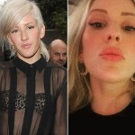 Ellie Goulding before and after lip surgery (4)
