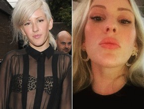 Ellie Goulding before and after lip surgery (4)