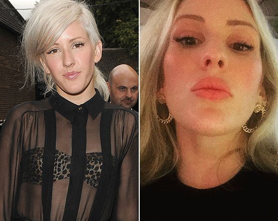 Ellie Goulding before and after lip surgery (4) .