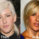 Ellie Goulding before and after plastic surgery (18)