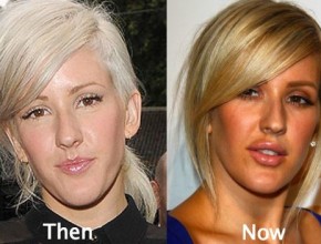 Ellie Goulding before and after plastic surgery (18)