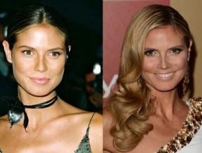 Heidi Klum before and after plastic surgery (20)