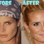 Heidi Klum before and after plastic surgery (26)