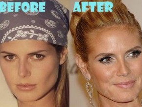 Heidi Klum before and after plastic surgery (26)