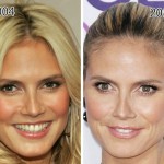 Heidi Klum before and after plastic surgery (27)