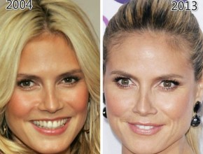 Heidi Klum before and after plastic surgery (27)