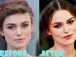 Keira Knightley Plastic Surgery (22)