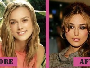 Keira Knightley Plastic Surgery (26)