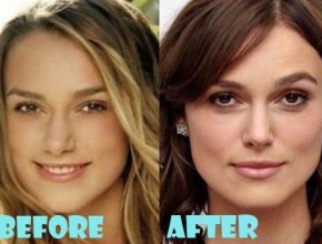 Keira Knightley Plastic Surgery (28)