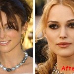 Keira Knightley Plastic Surgery (8)