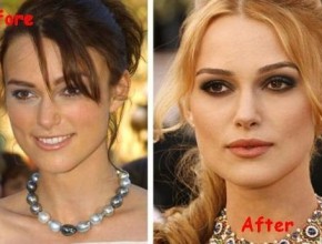 Keira Knightley Plastic Surgery (8)