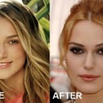 Keira Knightley before and after Plastic Surgery (2)