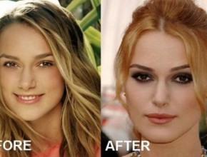 Keira Knightley before and after Plastic Surgery (2)