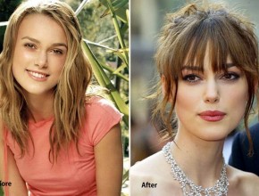 Keira Knightley before and after Plastic Surgery