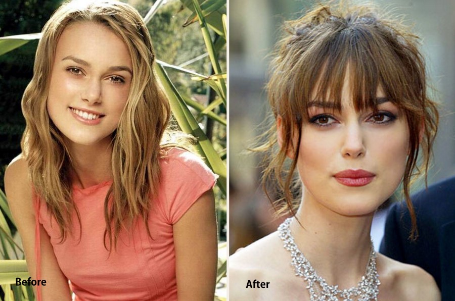 Keira Knightley before and after Plastic Surgery