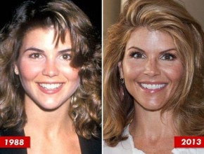 Lori Loughlin before and after plastic surgery